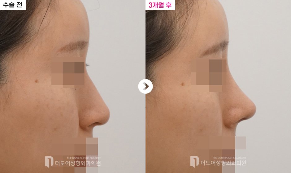 코 재수술 전후 — 전후사진
