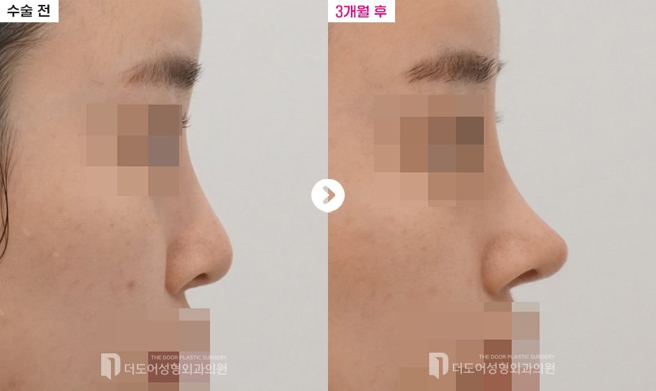 코 재수술 전후 — 전후사진