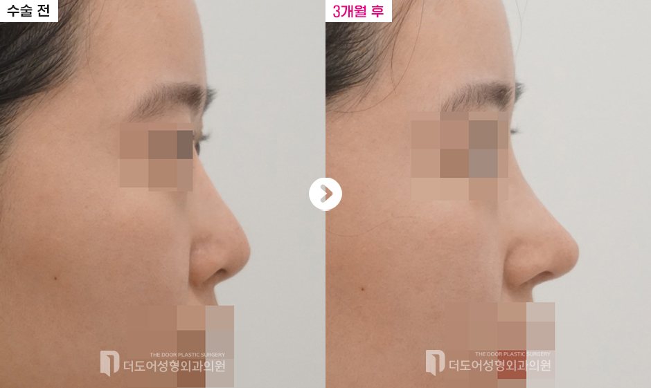 코 재수술 전후 — 전후사진