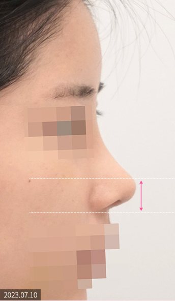 같은 환자 수술 2주 후 옆모습(2023.07.10, 코끝 높이 표시선)