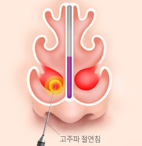비염 코성형 설명 그림 — 코 속 단면 그림 — 고주파 절연침으로 비갑개를 치료하는 모습