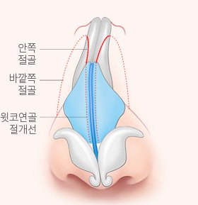 휜코 성형 설명 그림 — 정면 코뼈 그림 — 안쪽·바깥쪽 절골선과 윗코연골 절개선