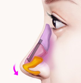짧은코·들창코 성형 설명 그림 — 옆모습 코 그림 — 코끝을 아래로 늘이는 화살표